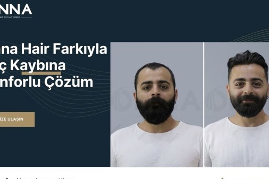 Onna Hair Güvencesiyle Saçlarınıza Yeniden Ulaşın!