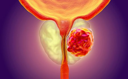 Erken teşhis edilen prostat kanseri neredeyse yüzde 100 tedavi edilebiliyor