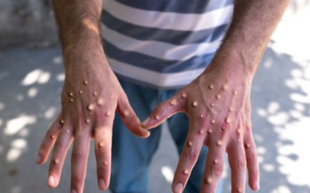 Maymun çiçeği virüsü bir ülkeye daha sıçradı!